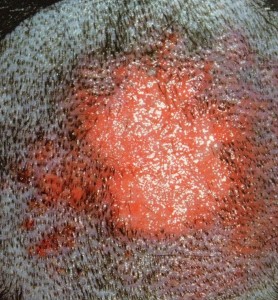 Dermatite piotraumática, associada a picada de pulga